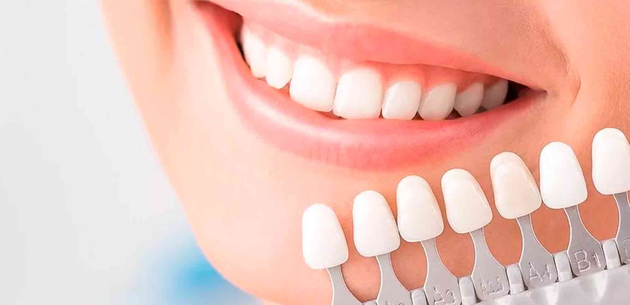 Композитні вініри