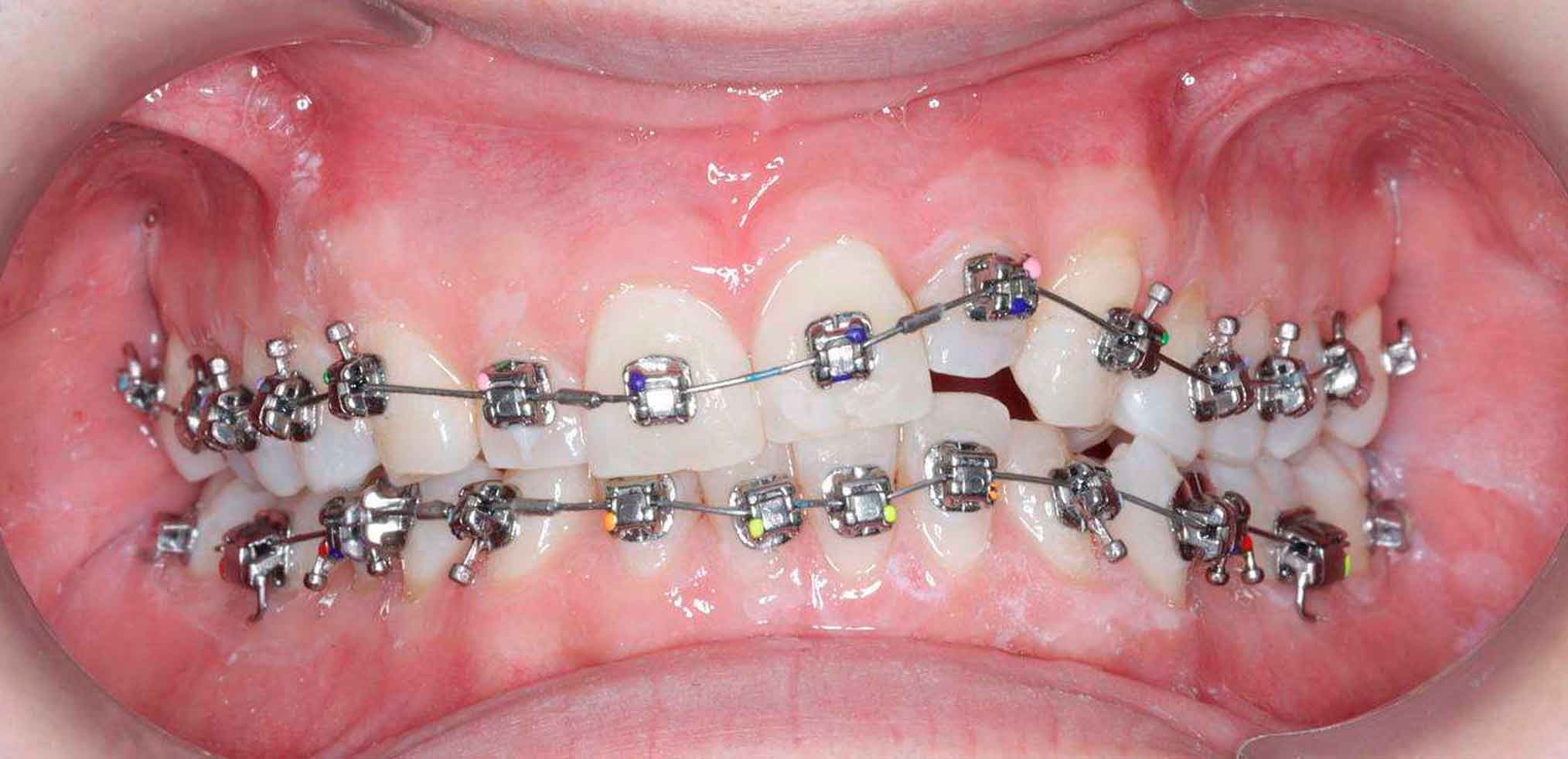 Металеві брекети на зуби