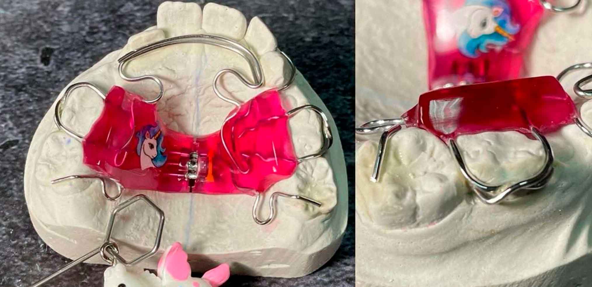 Пластинки на зуби