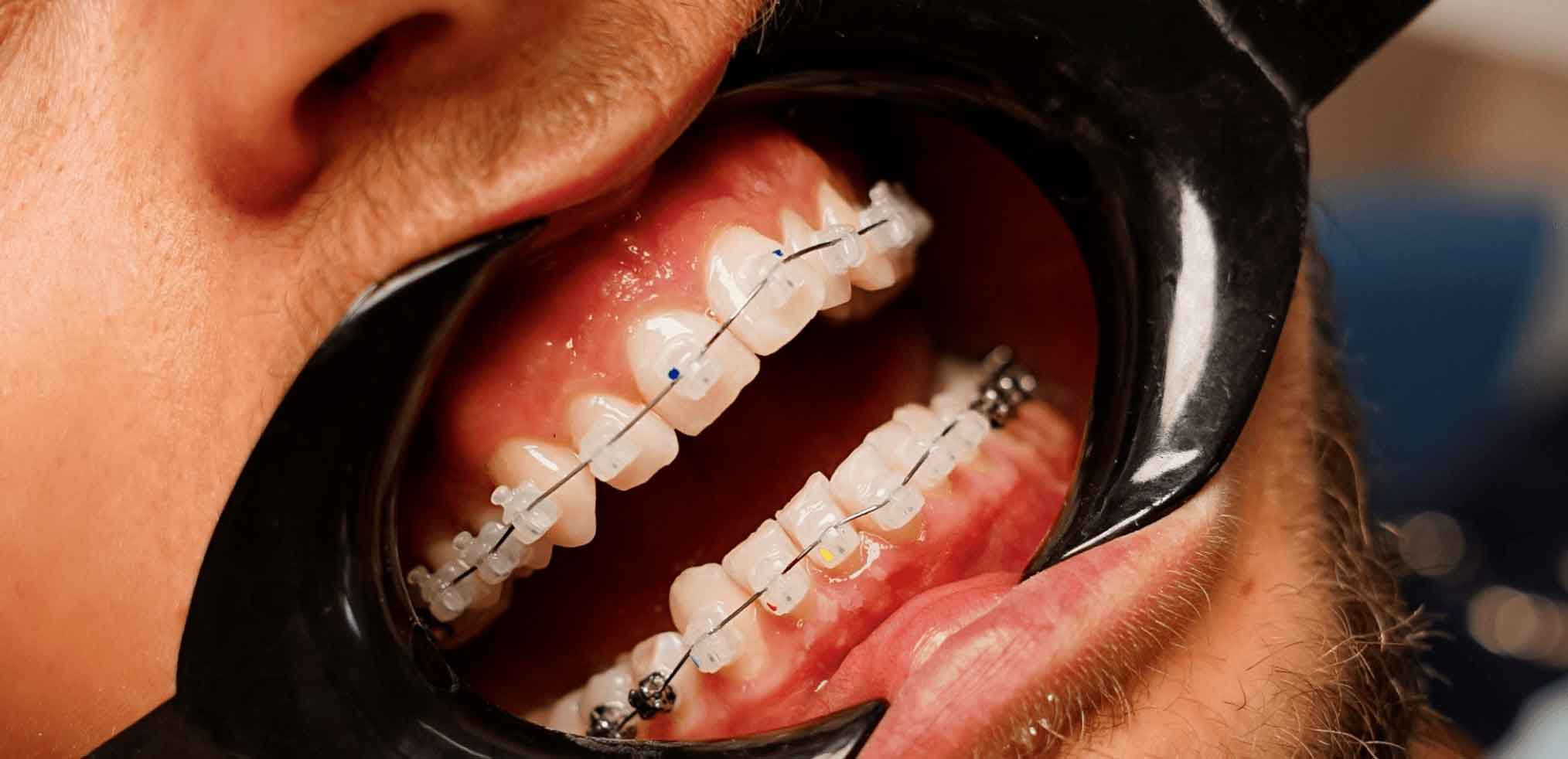 Самолігуючі брекети