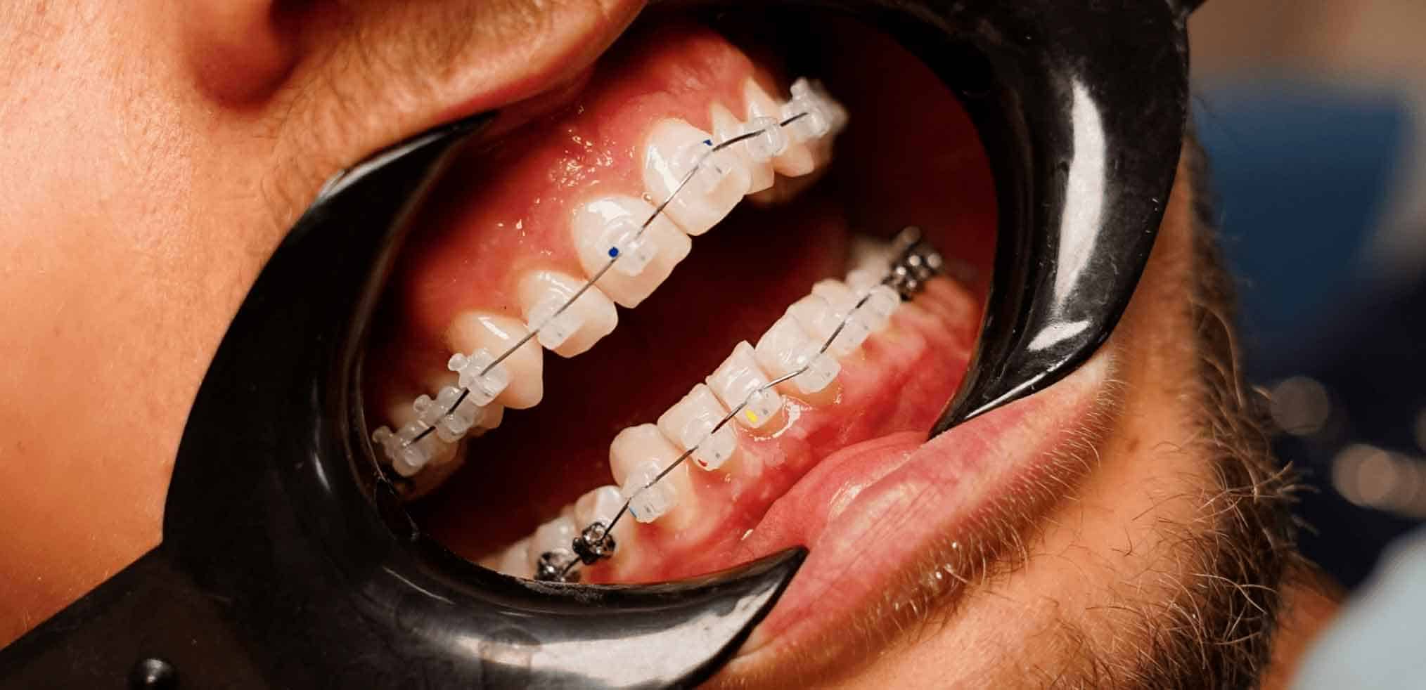 Сапфірові брекети