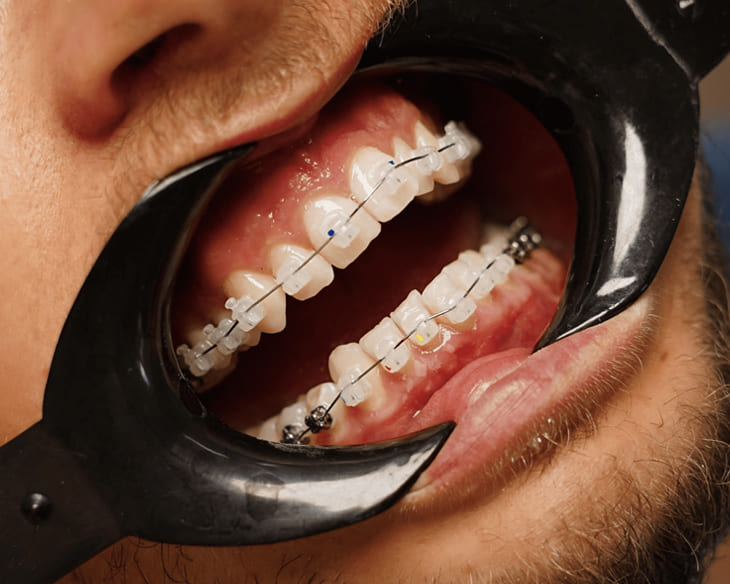 Як доглядати за брекетами?